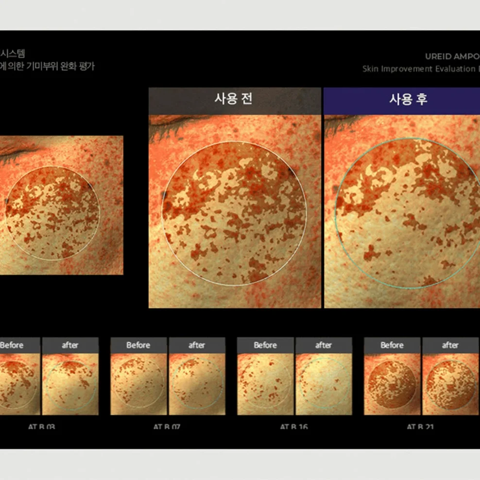 비에논 우레이드 기미앰플 검버섯 흑자 나이아신아마이드 미백앰플 상세 이미지 3